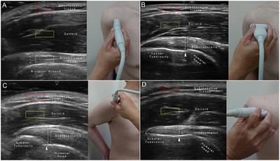 Sarcopenia Is Associated With Increased Risks of Rotator Cuff Tendon Diseases Among Community-Dwelling Elders: A Cross-Sectional Quantitative Ultrasound Study